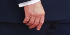 Memar tangan Trump (Aaron Rupar)